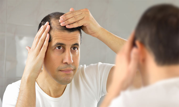 Rụng tóc nhiều ở nam giới là bệnh gì Địa chỉ chữa rụng tóc uy tín